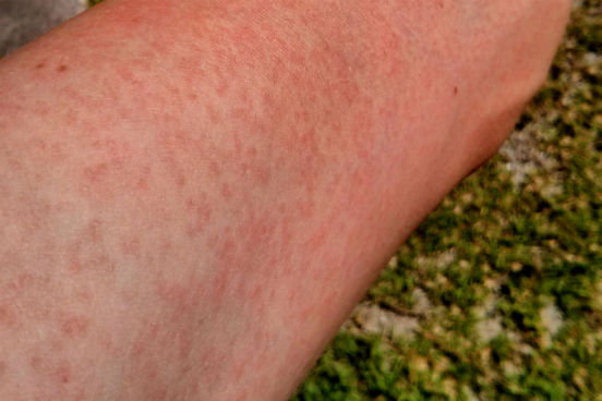 A literatura afirma que mais de 80% das pessoas infectadas com o zika vírus não desenvolvem nenhum sintoma. No entanto, as manifestações clínicas que podem ocorrer são: febre, manchas no corpo (como mostra a foto) e dores na articulação. Caso a pessoa infectada seja uma mulher grávida, o zika pode atacar o bebê. As hipóteses são de que ele invade a placenta, entrando na corrente sanguínea do feto e assim chegando diretamente ao seu cérebro, causando nele uma má-formação. (Imagem: Wikimedia Commons) A literatura afirma que mais de 80% das pessoas infectadas com o zika vírus não desenvolvem nenhum sintoma. No entanto, as manifestações clínicas que podem ocorrer são: febre, manchas no corpo (como mostra a foto) e dores na articulação. Caso a pessoa infectada seja uma mulher grávida, o zika pode atacar o bebê. As hipóteses são de que ele invade a placenta, entrando na corrente sanguínea do feto e assim chegando diretamente ao seu cérebro, causando nele uma má-formação. (Imagem: Wikimedia Commons)