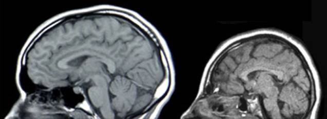 A microcefalia é uma condição neurológica que leva a um déficit no crescimento do cérebro durante a gestação. Em 90% dos casos, ela pode causar distúrbios neurológicos como a epilepsia, problemas de visão e de audição e até retardo mental. A imagem mostra duas tomografias da cabeça lado a lado - a da esquerda é considerada normal e a esquerda é de um paciente com microcefalia. (Imagem: Wikimedia Commons) A microcefalia é uma condição neurológica que leva a um déficit no crescimento do cérebro durante a gestação. Em 90% dos casos, ela pode causar distúrbios neurológicos como a epilepsia, problemas de visão e de audição e até retardo mental. A imagem mostra duas tomografias da cabeça lado a lado - a da esquerda é considerada normal e a esquerda é de um paciente com microcefalia. (Imagem: Wikimedia Commons)